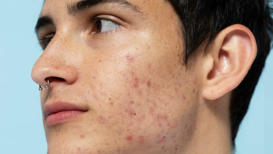 Can You Use an Electric Shaver If You Have Acne or Ingrown Hairs? A Sensitive Skin Guide